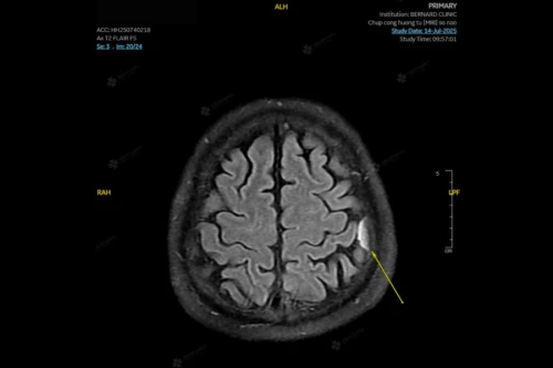 U màng não là gì? U màng não có nguy hiểm không?
